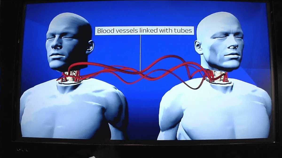 The Era of BrainBridge AI: A New Frontier in Head Transplantation
